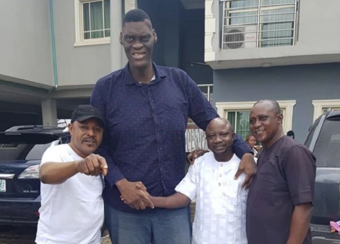 afeez agoro suffers from acromegaly or gigantism